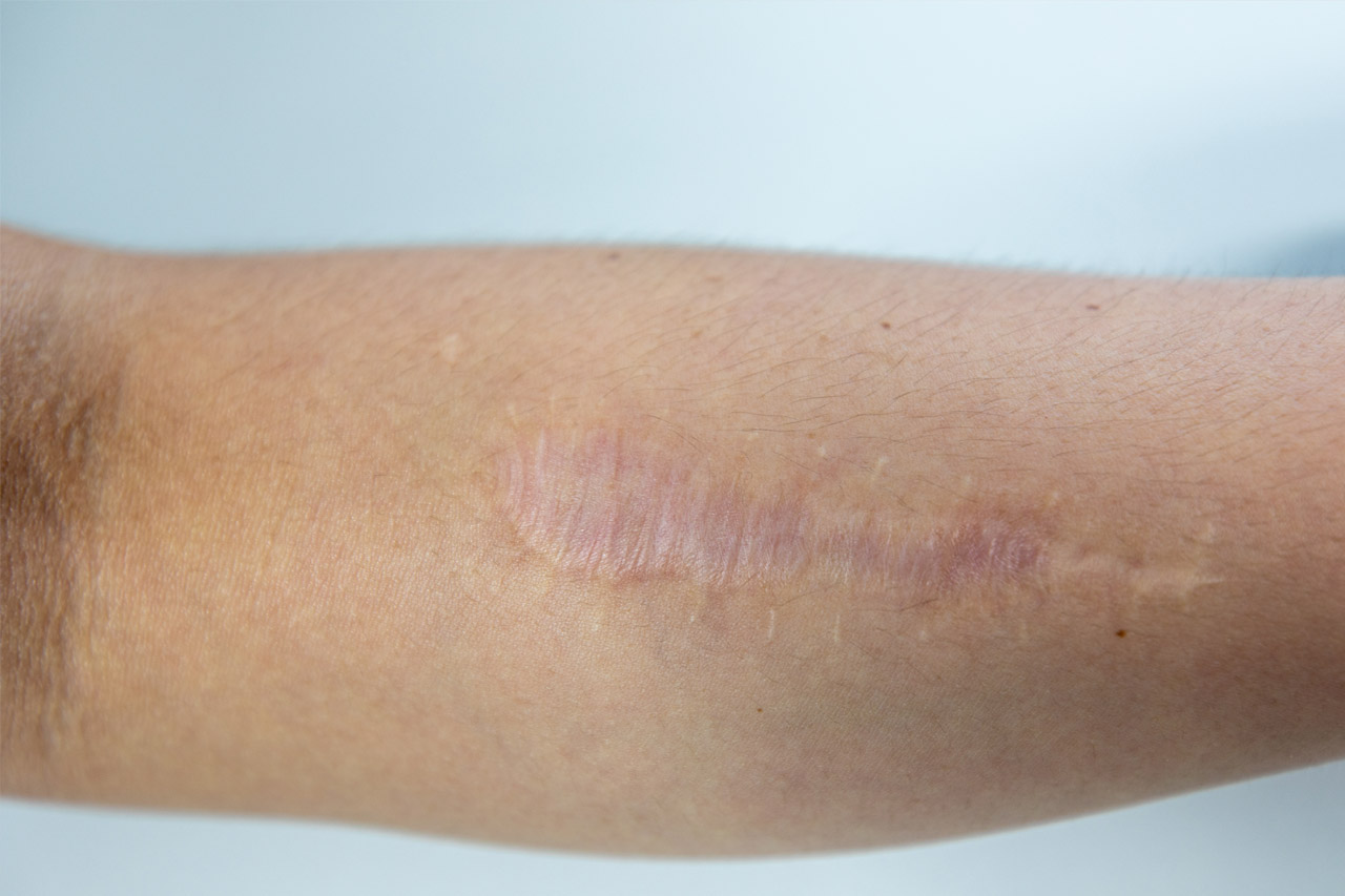 Cicatrice atrophie : Comment les faire disparaitre ?