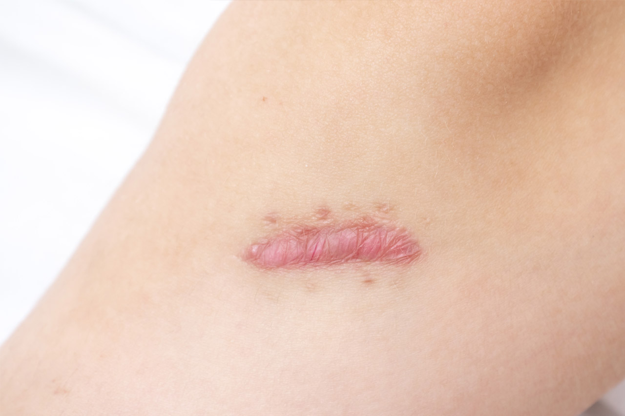 Cicatrice chéloïde : les meilleures traitements pour les atténuer : Femme  Actuelle Le MAG