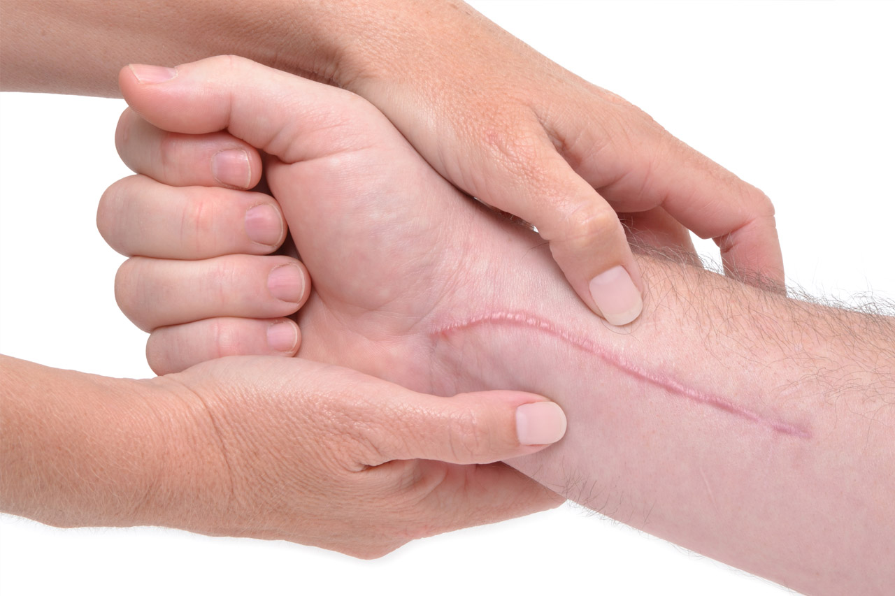Cicatrice cheloide : quelles solutions pour la faire disparaitre ?